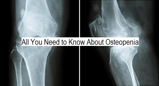 all-you-need-to-know-about-Osteopenia