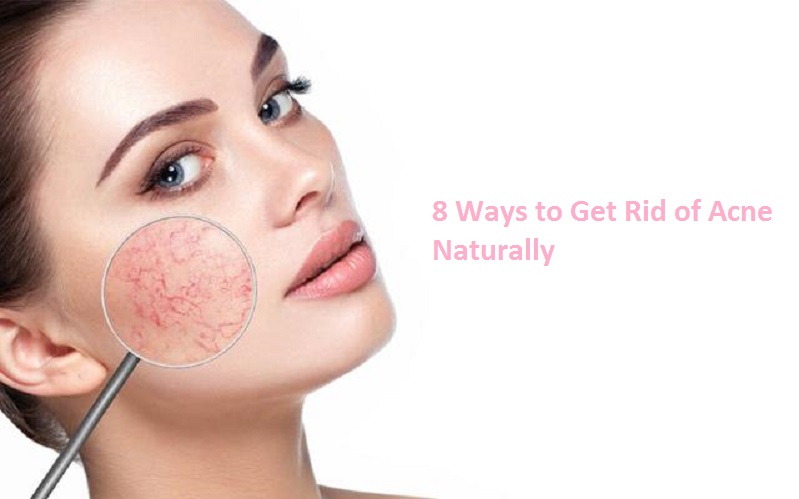 8 Ways to Get Rid of Acne Naturally