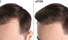 Best Hair Transplant in Islamabad: A Comprehensive Guide