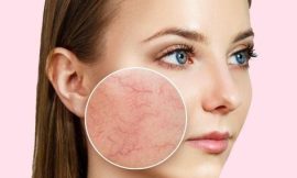 Laser and Light Therapy for Rosacea Redness Reduction