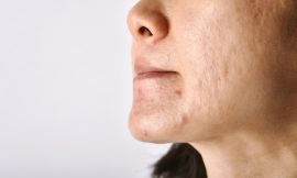 Clear Acne Quickly with Dubai’s Laser Acne Treatment