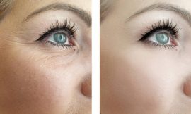 Understanding Blepharoplasty Under Eye Surgery: A Comprehensive Guide to Achieving a Youthful Appearance