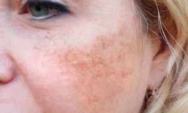 Acupuncture and Massage for Rosacea Relaxation and Relief