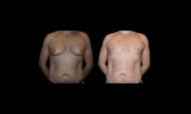 What Should I Do If I Experience Complications After Gynecomastia Surgery?