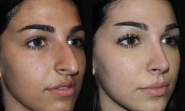 Is Rhinoplasty More Difficult for Men or Women?