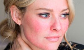 Natural Remedies for Rosacea Herbal Supplements and Essential Oils