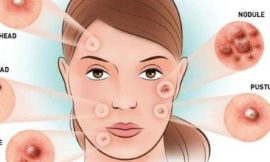 How to get rid of Acne always?