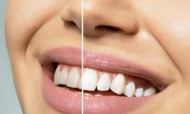 Teeth Whitening Myths: Separating Fact from Fiction