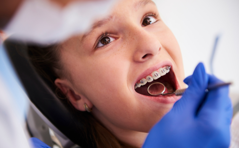 Read more about the article How to Care for Braces: A Guide for Kids and Parents