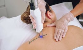 The Best Ways to Prevent Tattoo Removal Scarring