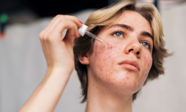 How to Treat Acne Fast: Best Products and Therapies