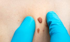 Skin Tag Removal: A Step-by-Step Guide