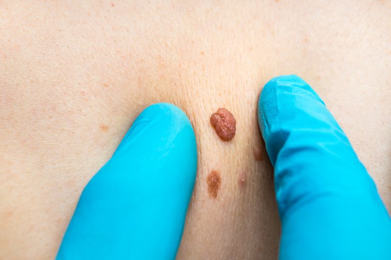 Read more about the article Skin Tag Removal: A Step-by-Step Guide