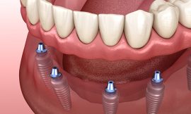 Dental Implants Everything You Need to Know