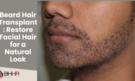 Beard Hair Transplant: Restore Facial Hair for a Natural Look