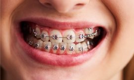 The Pros and Cons of Metal Braces for Your Dental Needs