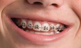 Achieving a Perfect Smile: Top Teeth Braces Options Explained