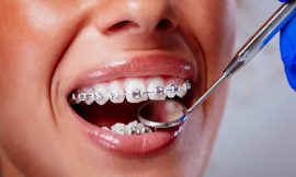 Metal Braces: Achieving a Beautiful Smile Together