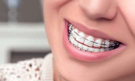 Metal Braces in Dubai: A Smart Choice for Orthodontics