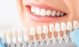 Composite Veneers: Real Results in Smile Transformation