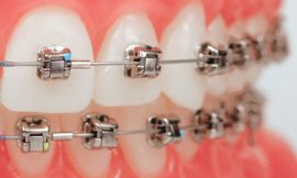 Say Goodbye to Misaligned Teeth with Metal Braces