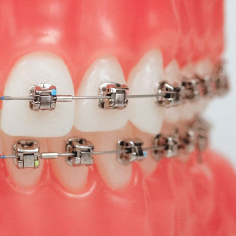 Read more about the article Metal Braces in Dubai: Quality Care for Your Teeth