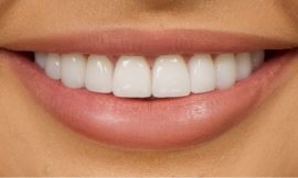 Dental Veneers in Dubai: Your Smile, Your Style