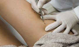 How to Remove Skin Tags on Inner Thigh: Safe Practices