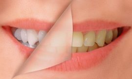 The Best Teeth Whitening Solutions for Sensitive Teeth in Dubai