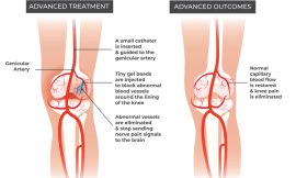 Genicular Artery Embolization: A Minimally Invasive Treatment for Knee Pain by Flowcare