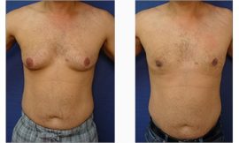 Gynecomastia Surgery in Dubai: Expert Care and Results