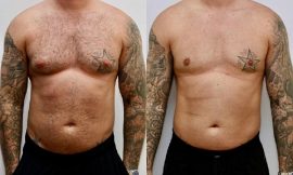 Building a Trusting Relationship with Your Best Gynecomastia Surgeon in Dubai