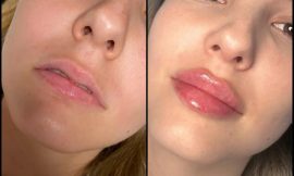 Understanding Different Juvederm Products: A Guide by the Best Juvederm Fillers Dermatologist in Dubai