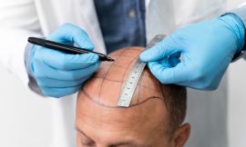 How Much Should You Expect to Pay for a Hair Transplant in Dubai?