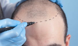 Investing Wisely: How to Choose the Right Hair Transplant Package in Dubai