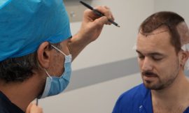 Hair Transplant Cost: Planning for Your New Look