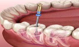 Is Dubai’s Tooth Filling Quality Worth the Price