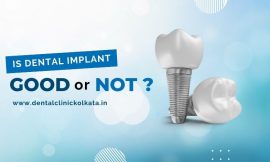 Is Dental Implant Good or Not?