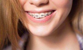 Find Your Perfect Fit with Metal Braces in Dubai