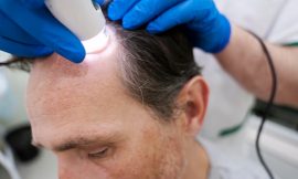 Hair Transplant Cost: Planning Your Procedure