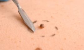 Skin Tag Removal: Over-the-Counter Options