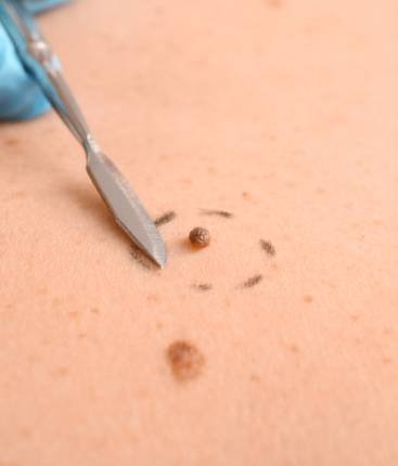 Read more about the article Skin Tag Removal: Over-the-Counter Options