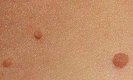 How to Remove Skin Tags on Inner Thigh: Myths Debunked