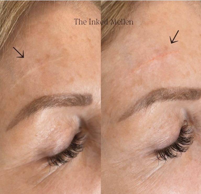 Read more about the article Revitalize Your Skin with JetPeel Facial and Scar Camouflage Tattooing