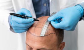 Hair Transplant Costs in Dubai: A Detailed Look at Prices and Factors