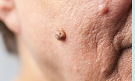 Skin Tags Removal: Professional vs. DIY Solutions