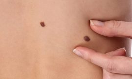 The Cost of Beauty: Skin Tag Removal Prices in Dubai