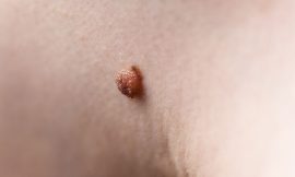 How to Remove Skin Tags on Inner Thigh: Solutions That Work