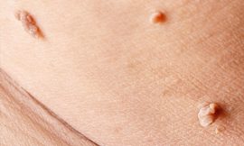 Say Goodbye to Skin Tags Today!