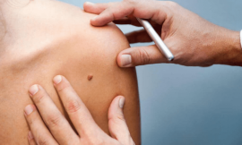 Get Rid of Skin Tags for Good